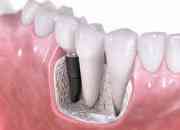 Dental Excellence and Dental Implant London