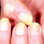 What is Fungus toenail?
